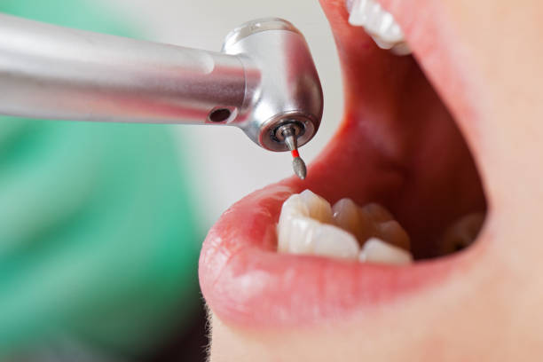 Best Root Canal Emergency Dentist  in Energy, IL